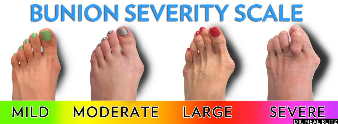 Bunion là gì? Bạn có đang gặp tình trạng biến dạng này?