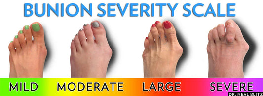 Bunion là gì? Bạn có đang gặp tình trạng biến dạng này?